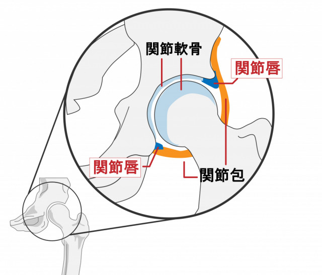 股関節症