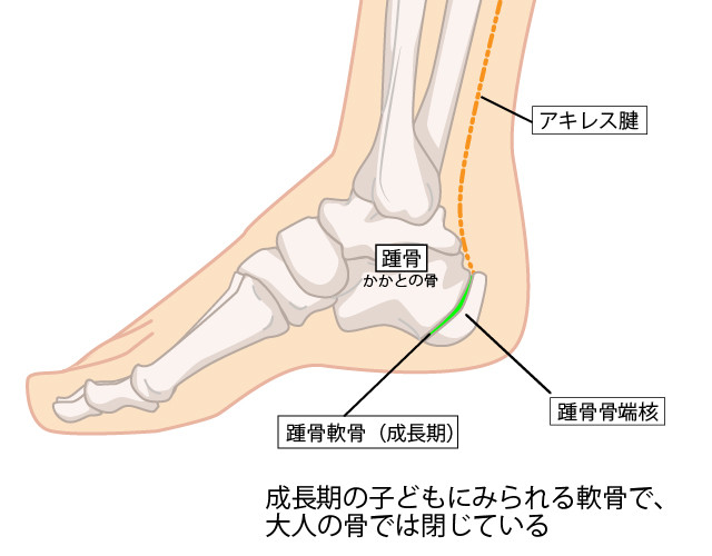踵骨骨端核のイラスト